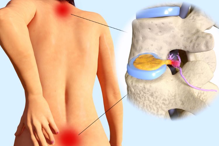 Herniated Discs and Spinal Health