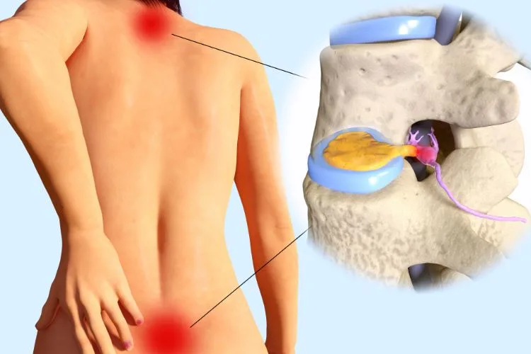 Herniated Discs and Spinal Health