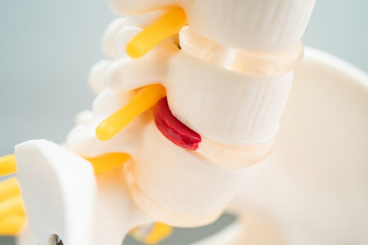 The Role of Upper Cervical Care in Treating Herniated Discs