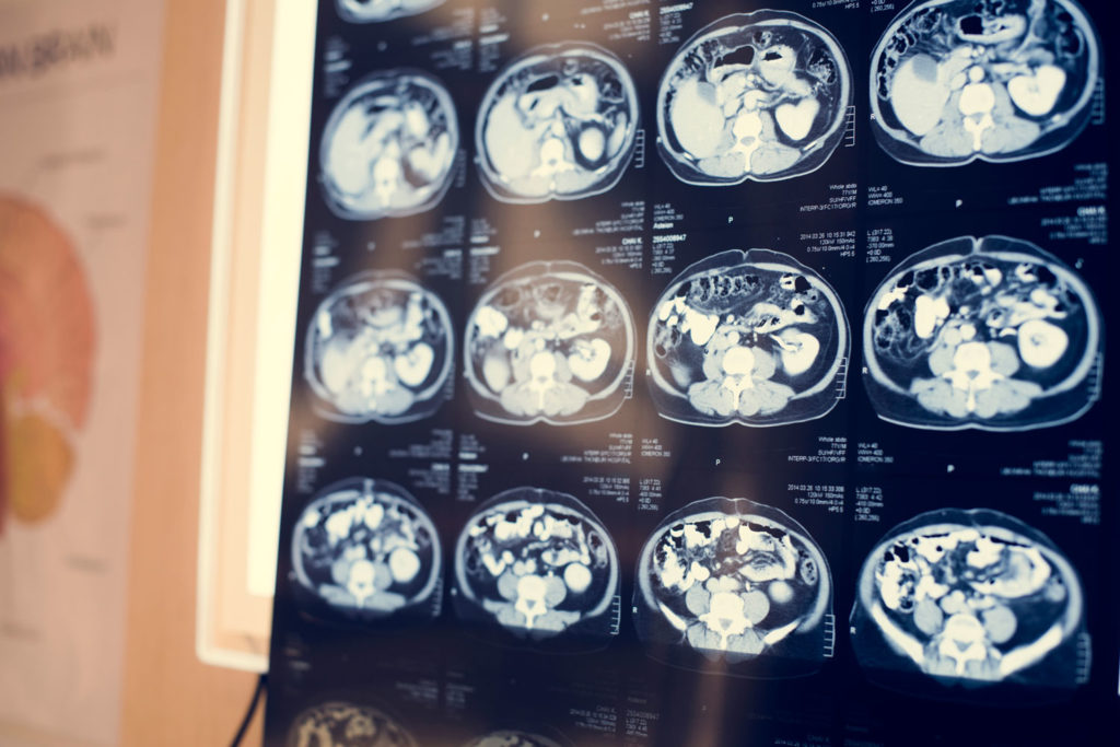 Brain CT Scan x-ray Film