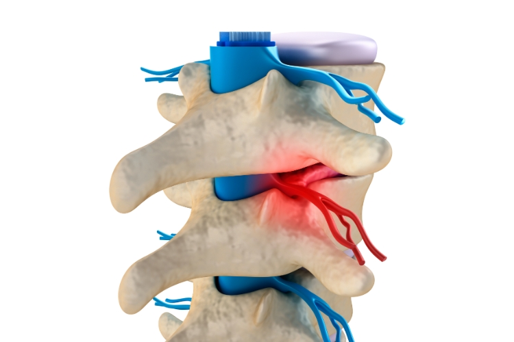 Bridging Relief- Upper Cervical Chiropractic's Role in Managing Spinal Stenosis