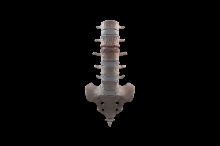 Bridging Relief- Upper Cervical Chiropractic's Role in Managing Spinal Stenosis
